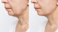 Jawline Sculpting Treatment – Image 4