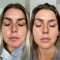 3 IPL Face Treatments – Image 2