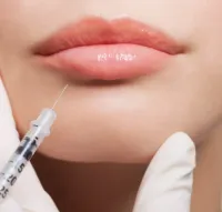 1 Vial Lip Filler – Image 1