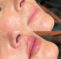 1 Vial Lip Filler – Image 2