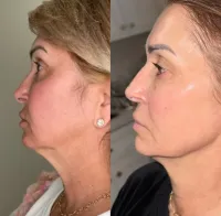 Forma Neck Tightening – Image 2