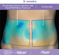 Alastin TransFORM Body Treatment – Image 2