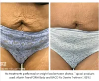 Alastin TransFORM Body Treatment – Image 3