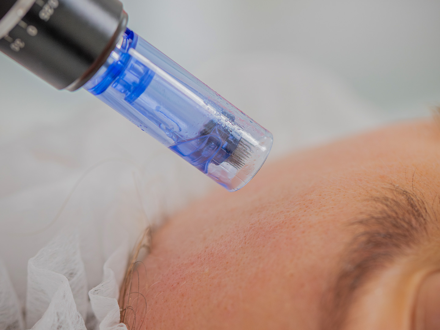 Microneedling Pen with Exosome Booster – Face – Image 2
