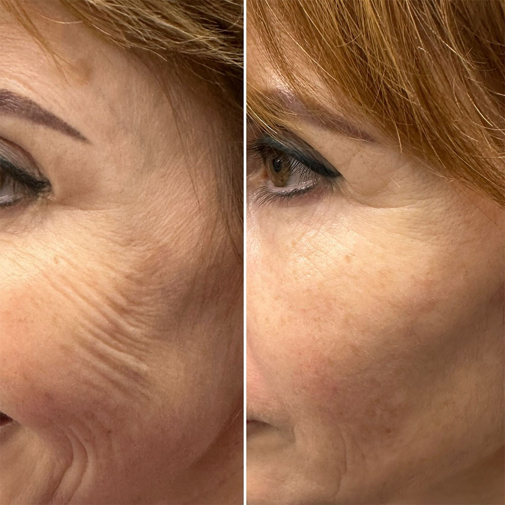 Microneedling Pen with Exosome Booster – Face – Image 3