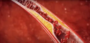 Blood vessel constriction