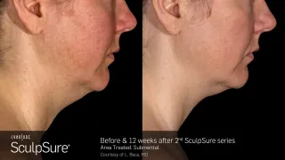 SculpSure Double Chin Treatment Clifton NJ | No Surgery