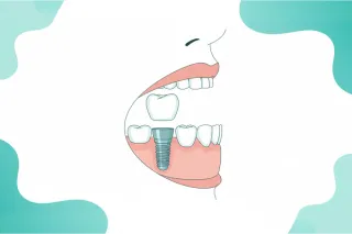 Immediate Implant Placement: Pros, Risks & Protocols