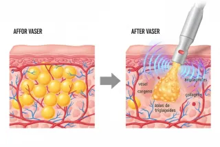 Lipo Vaser vs. Tradicional: Diferencias, Riesgos y Retracción