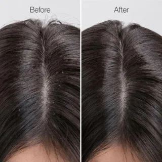 How Head Spa Helps with Dandruff