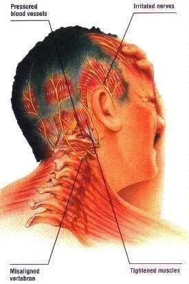 Can Neck Tension Cause Migraines? (Simple Explanation)