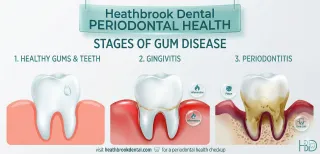 7 Signs You Might Have Gum Disease