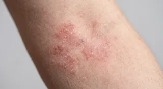 Chronische Hautprobleme lindern: Ganzheitliche Medizin & Hypnose bei Neurodermitis, Akne, Psoriasis & Rosazea
