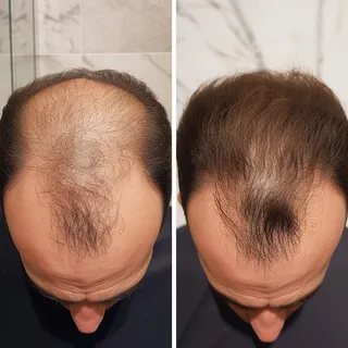 PRP Hair Treatment for Men in Enfield | Hair Loss Help