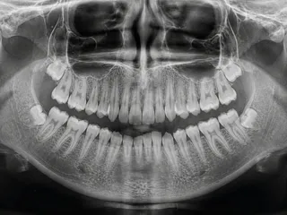 What Causes Bone Loss Around Dental Implants?