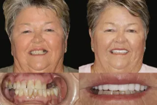 The Complete Guide to Teeth Whitening Before & After Results