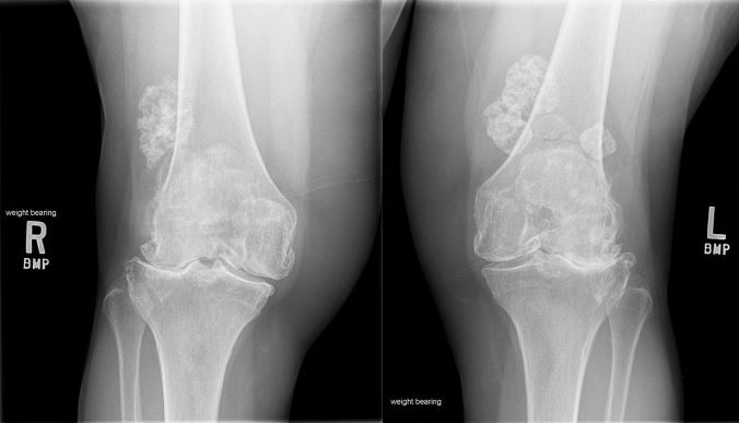 Knee Osteoarthritis