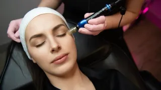 The Summer Glow-Up: Why Now is the  Perfect Time for Microneedling