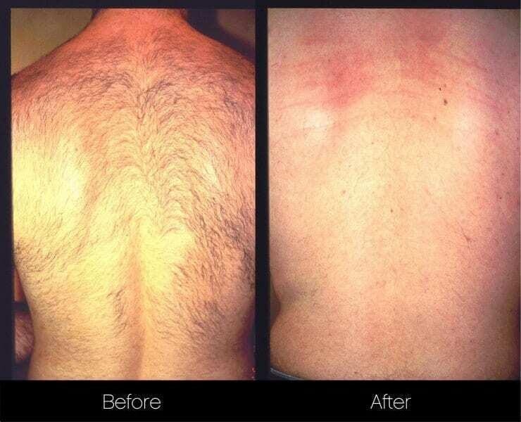 Medical Research: A New Approach to Laser Hair Removal