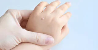 What Causes Warts?