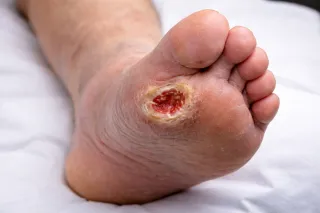 ULCERE DIABETICHE: PROTOCOLLO RIGENERATIVO PER EVITARE AMPUTAZIONI