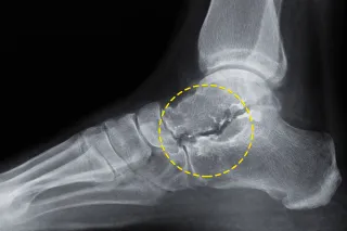 OSTEOARTROSI DELL'ASTRAGALO: COME RICONOSCERLA E TRATTARLA SENZA CHIRURGIA