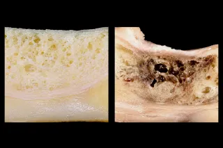 CAVITAZIONI MASCELLARI: POSSIBILI CAUSE DI DOLORE CRONICO E STANCHEZZA
