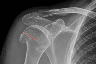   FRATTURA INGRANATA DELLA SPALLA NELL'ANZIANO CON OSTEOPOROSI: COME GUARIRE E TORNARE AUTONOMI