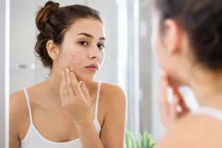 HAI L'ACNE E TI VERGOGNI DEL TUO VISO? NON SEI SOLA
