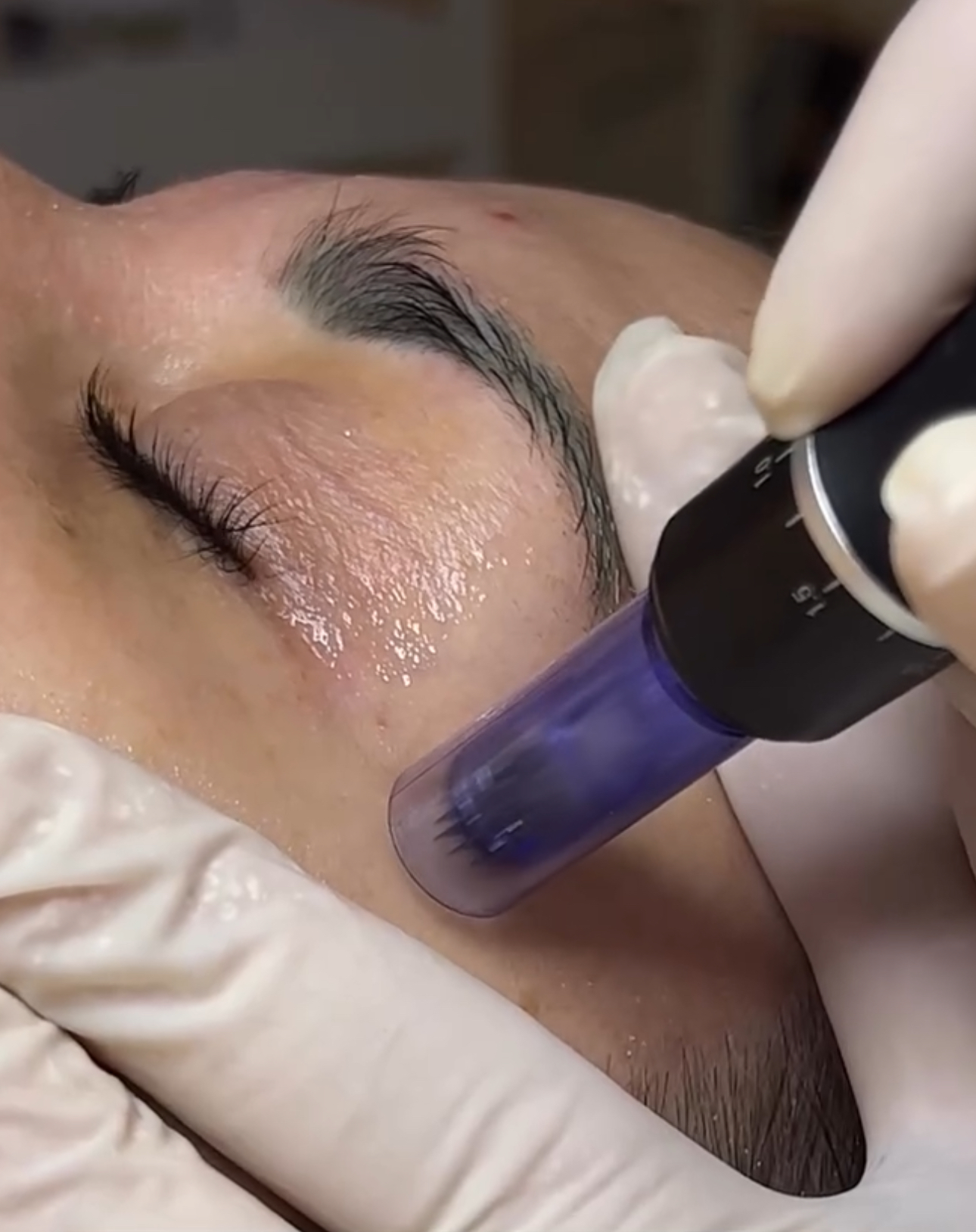 Microneedling Facial