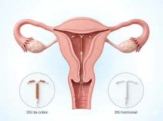 DIU : qué esperar (cobre u hormonal) y cuándo conviene revisarlo - Tijuana