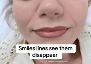 Smile Lines and Facial Expression: Understanding a Clinic Photo