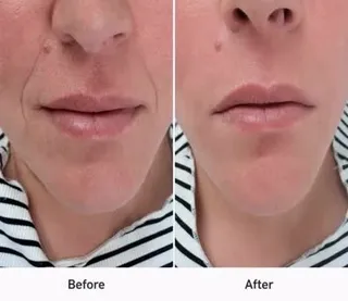 Nasolabial Folds: Looking Beyond the Smile Line