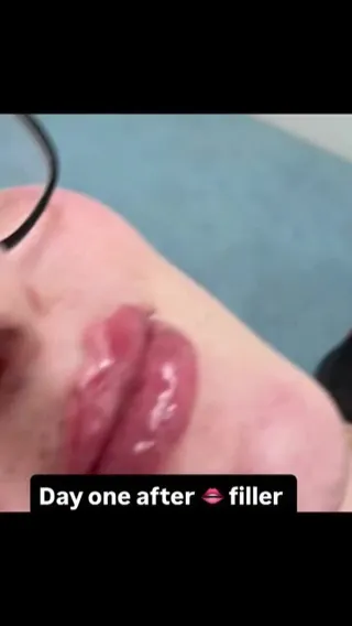 Lip Filler the Next Day: Why Early Photos Need Context