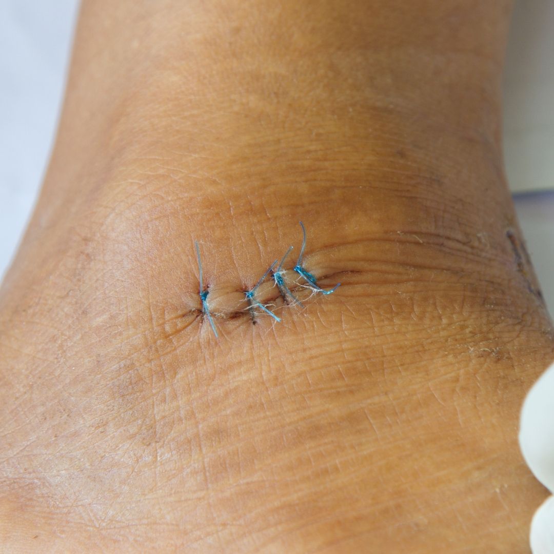 5 Dissolvable Stitches Healing Stages: Timeline and Recovery
