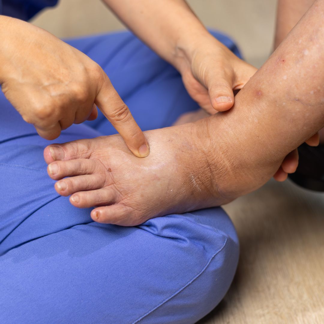 Diabetic Foot Ulcer Treatment in West Hills, California