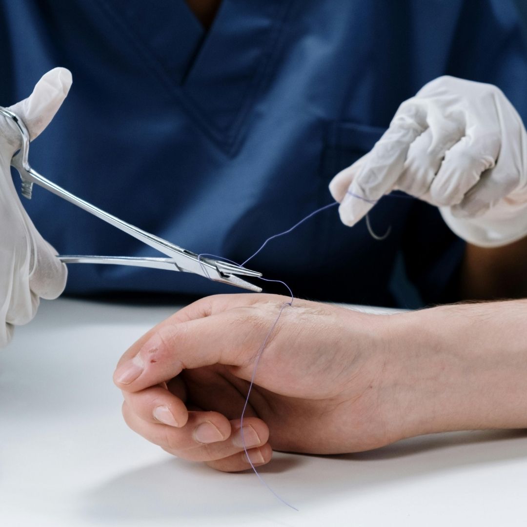 When Does a Wound Need Stitches