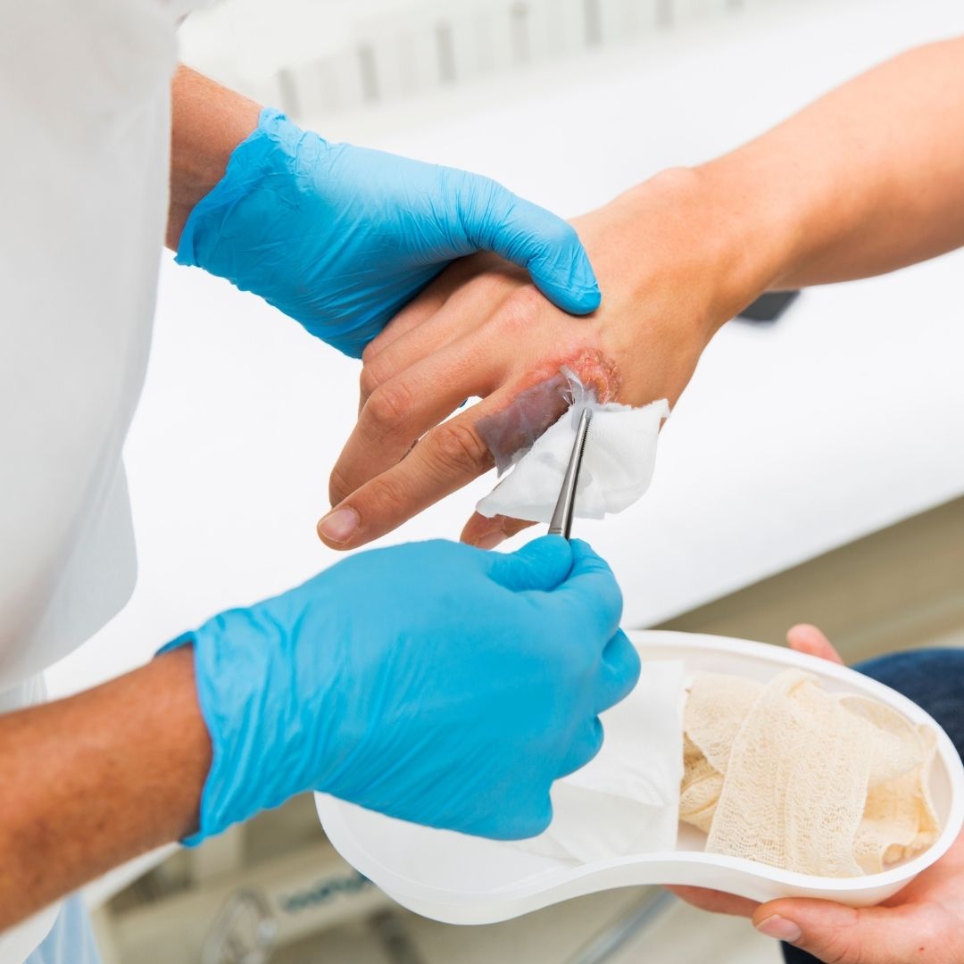 When to Discontinue Wound Vac Therapy: A Practical Guide