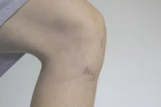 ACL Recovery Roadmap: Navigating the Long Road from Injury to High-Performance Return