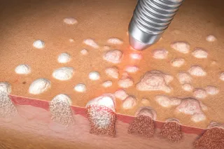 Laser Therapy for Genital Warts: What Men Should Know