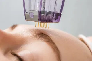 Morpheus8 for Acne Scars: Results, Recovery & Expectations