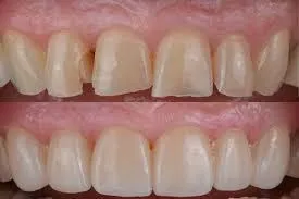 Dental Implant Complications & Warning Signs to Watch