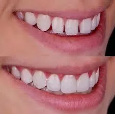Smile Makeover Cost Breakdown: What to Budget in 2026