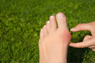 Bunions in Plymouth: Why Do They Develop and What Can You Do About Them?