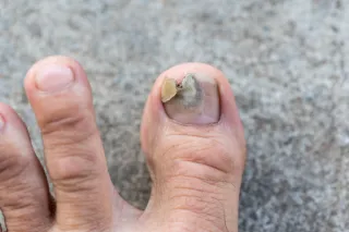 Fungal Nail Treatment in Plymouth: Why Won’t My Fungal Nail Go Away?