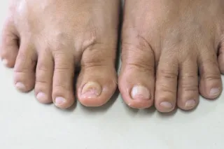 Fungal Nail Treatment in Plymouth: Why Fungal Toenails Can Be So Stubborn