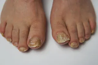 Why Do My Toenails Keep Getting Thicker? Podiatry Advice in Plymouth