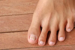 Painful Cracked Skin Between Your Toes? When to See a Podiatrist in Plymouth