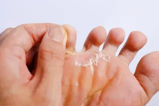 Athlete's Foot Treatment in Plymouth: Why That Itch Keeps Coming Back