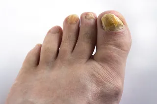 Yellow Toenails in Plymouth: Is It Fungus, Damage or Something Else?